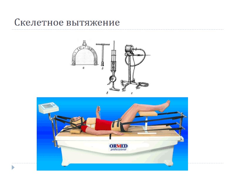 Скелетное вытяжение